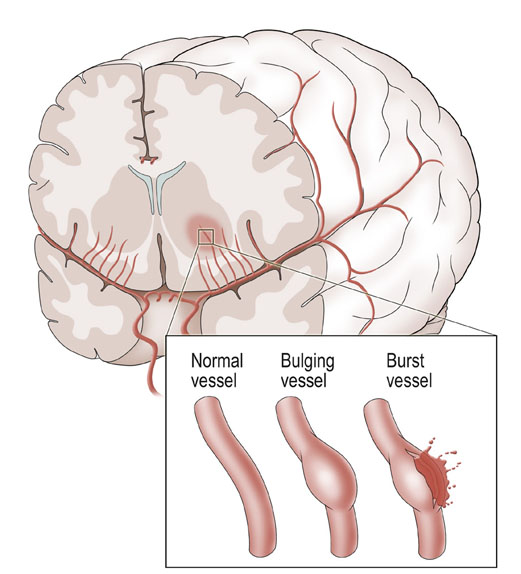 Hemorrhagic Stroke